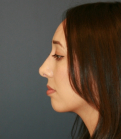 Feel Beautiful - Rhinoplasty 222 - After Photo